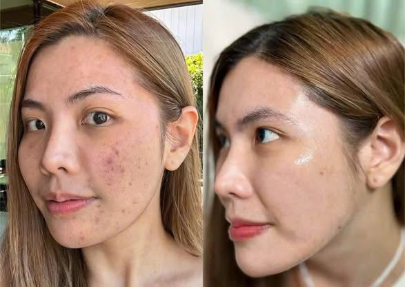 Những Sai Lầm Khi Điều Trị Thâm Mụn Khiến Da Lâu Hết